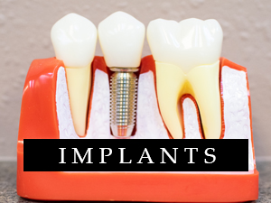 Implants